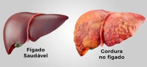 Como saber se você tem gordura no Fígado?